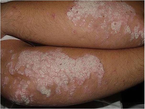 Brinda Secretaría de Salud atención dermatológica a través de Telemedicina