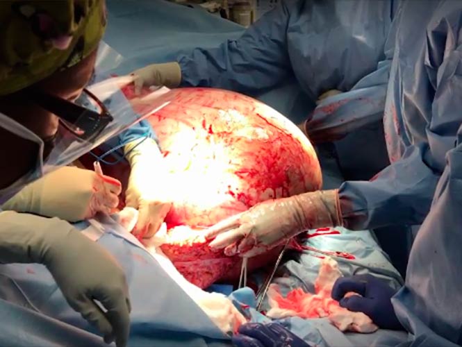 Extraen a mujer un tumor de más de 60 kilos