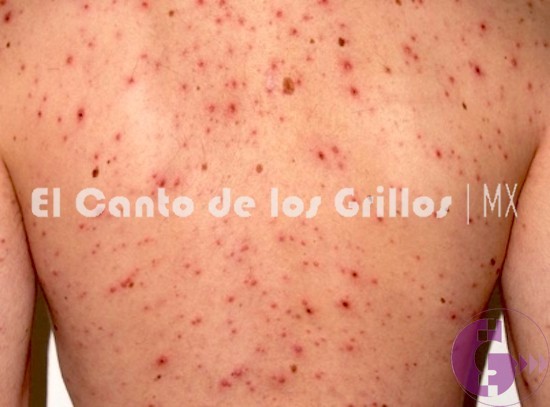 Confirma @SSalud_mx a mujer con #sarampión por contagio importado