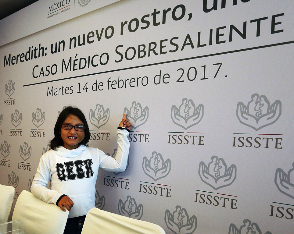 Reconstruye @ISSSTE_mx rostro a niña de 6 años tras accidente